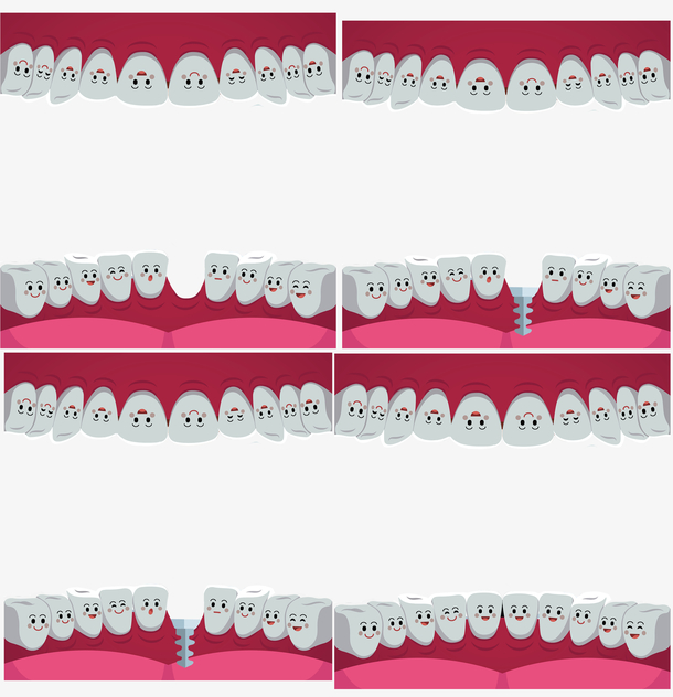 种植的牙齿过程